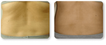 Before and After Treatment Back