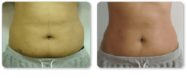 Before and After Treatment Tummy