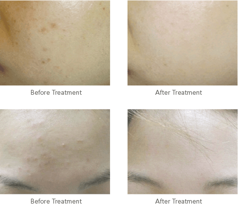 Before and after treatment