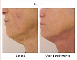Before and after 4 treatments