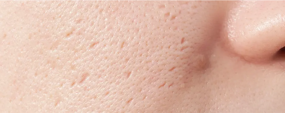 Clogged Pores