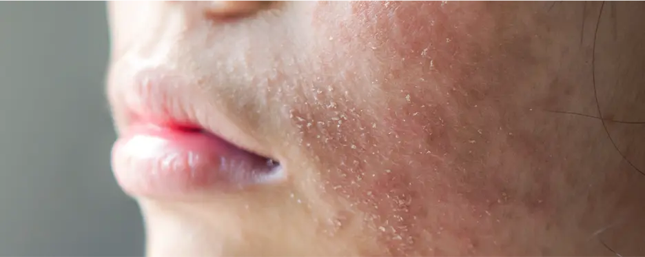 Dryness