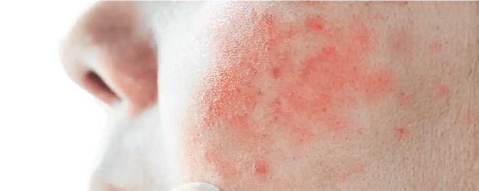 Sensitive Skin